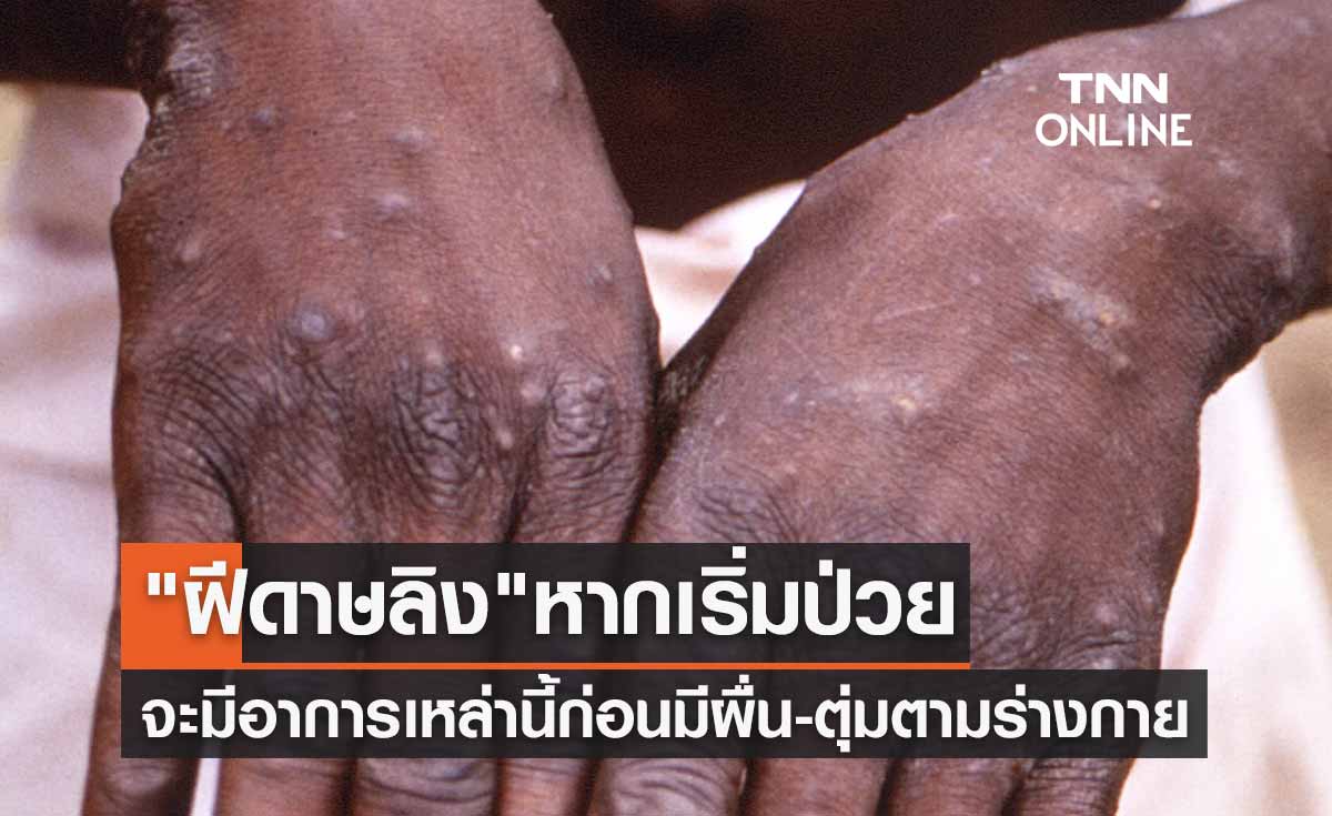 "ฝีดาษลิง" หากป่วยเริ่มต้นจะมีอาการเหล่านี้? ก่อนมีผื่น-ตุ่มขึ้นตามร่างกาย