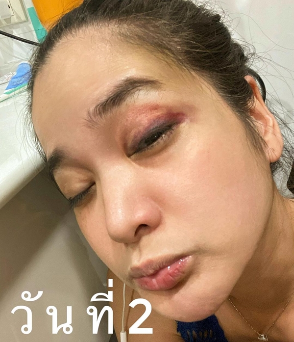 ปอย ปวีณา โพสต์ตาเขียวช้ำ เป็นอุทาหรณ์จากการเล่นสเก็ตบอร์ด ปอย ปวีณา โพสต์ตาเขียวช้ำ เป็นอุทาหรณ์จากการเล่นสเก็ตบอร์ด
