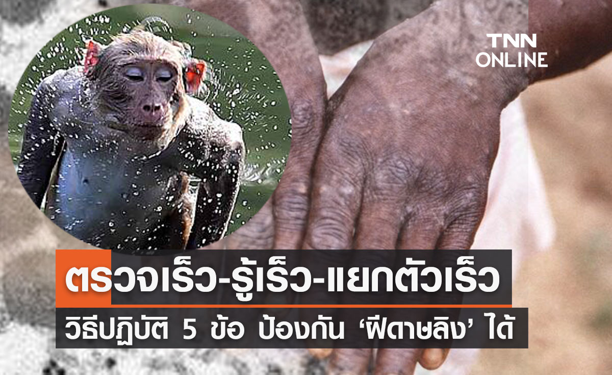 เปิดวิธีปฏิบัติ 5 ข้อ ตรวจเร็ว-รู้เร็ว-แยกตัวเร็ว ป้องกันการระบาดฝีดาษลิงได้ 