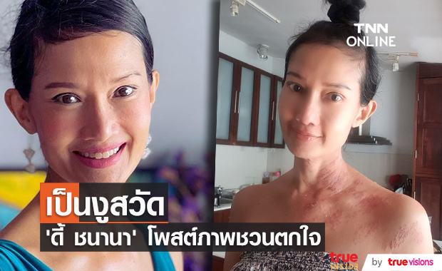 ดี้ ชนานา เผยภาพน่าตกใจ เป็นงูสวัดช่วงไหล่และคอ