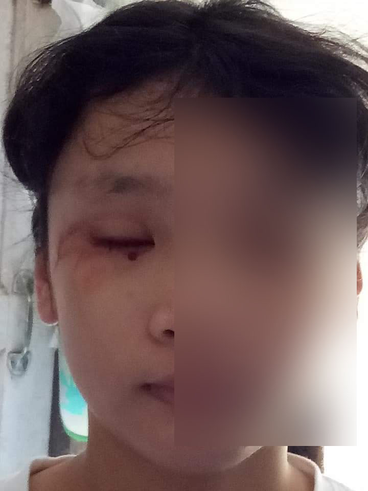 แม่โพสต์อุทาหรณ์! ลูกสาวเรียนออนไลน์-เล่นโทรศัพท์ เลือดออกในตา แม่โพสต์อุทาหรณ์! ลูกสาวเรียนออนไลน์-เล่นโทรศัพท์ เลือดออกในตา