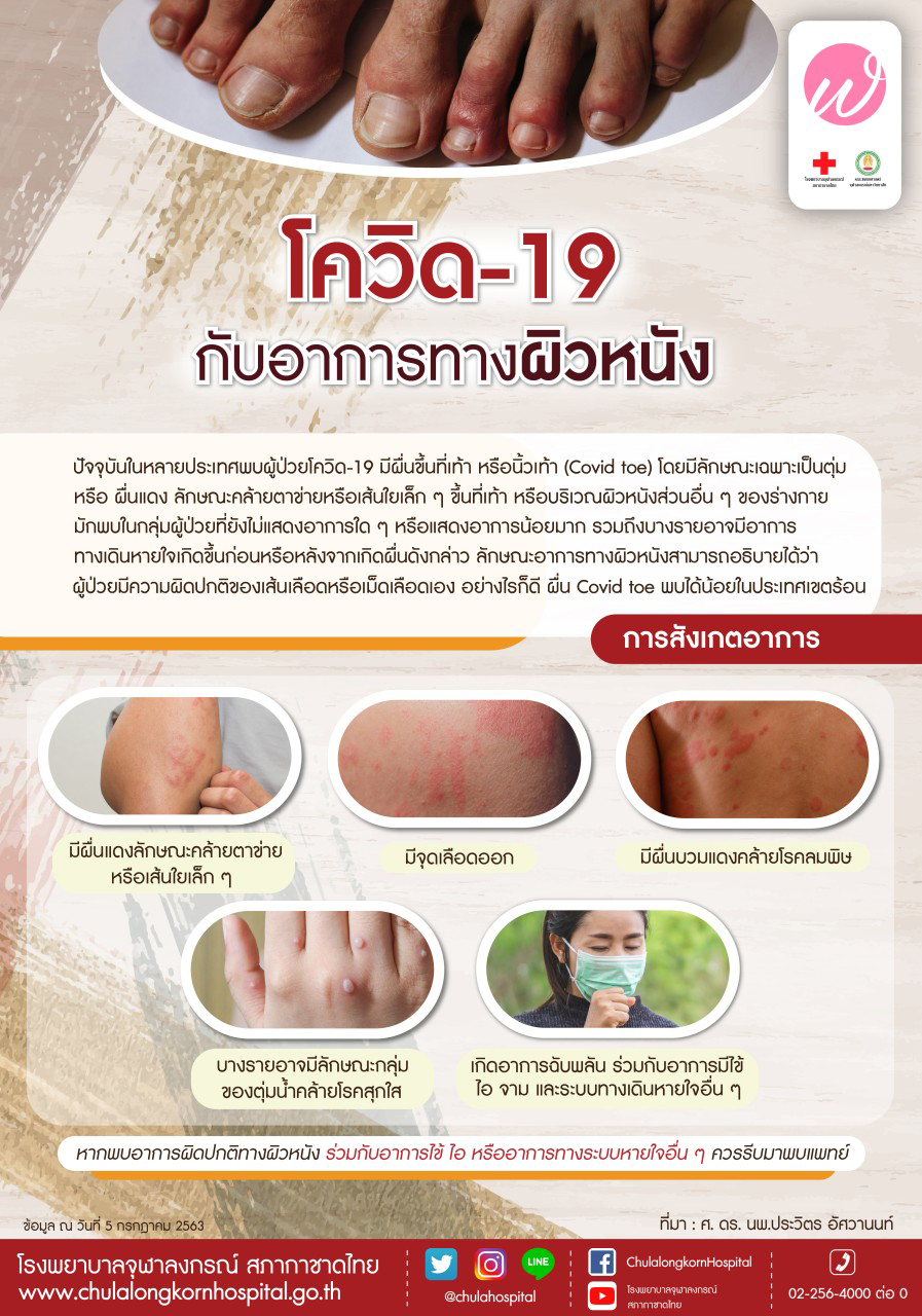 ผื่นแดงโควิดเป็นแบบไหน