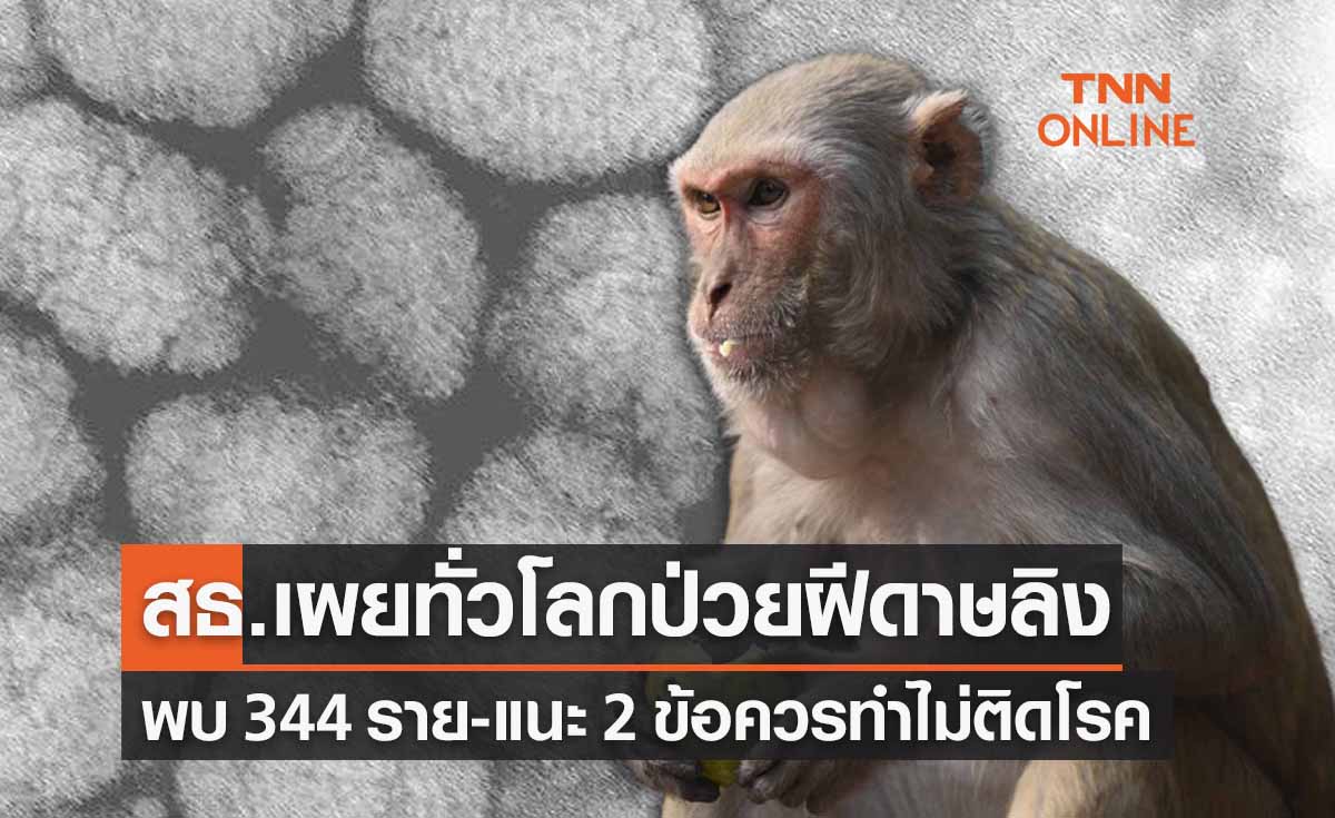 ฝีดาษลิง สธ.เผยทั่วโลกพบ 344 ราย แนะ 2 ข้อปชช.ควรทำห่างไกลติดเชื้อ