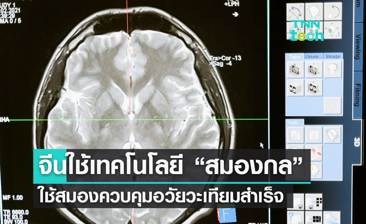จีนเผยใช้เทคโนโลยี สมองกล​ ใช้ความคิดควบคุมอวัยวะเทียมสำเร็จครั้งแรกของโลก