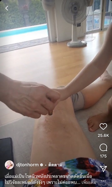 ต้นหอม เป็นโรคผิวหนังประหลาด หมอตัดชิ้นเนื้อไปวิจัย แต่ยังไม่รู้สาเหตุ
