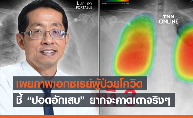 "หมอนิธิพัฒน์" ยกเคสผู้ป่วยโควิด บอกปอดอักเสบยากจะคาดเดาจริงๆ