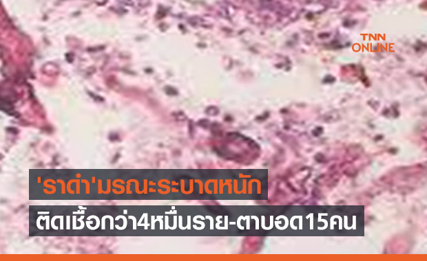 อินเดียสาหัส! ติดเชื้อราดำมรณะกว่า4หมื่นรายแล้ว พบตาบอดถึง15คน