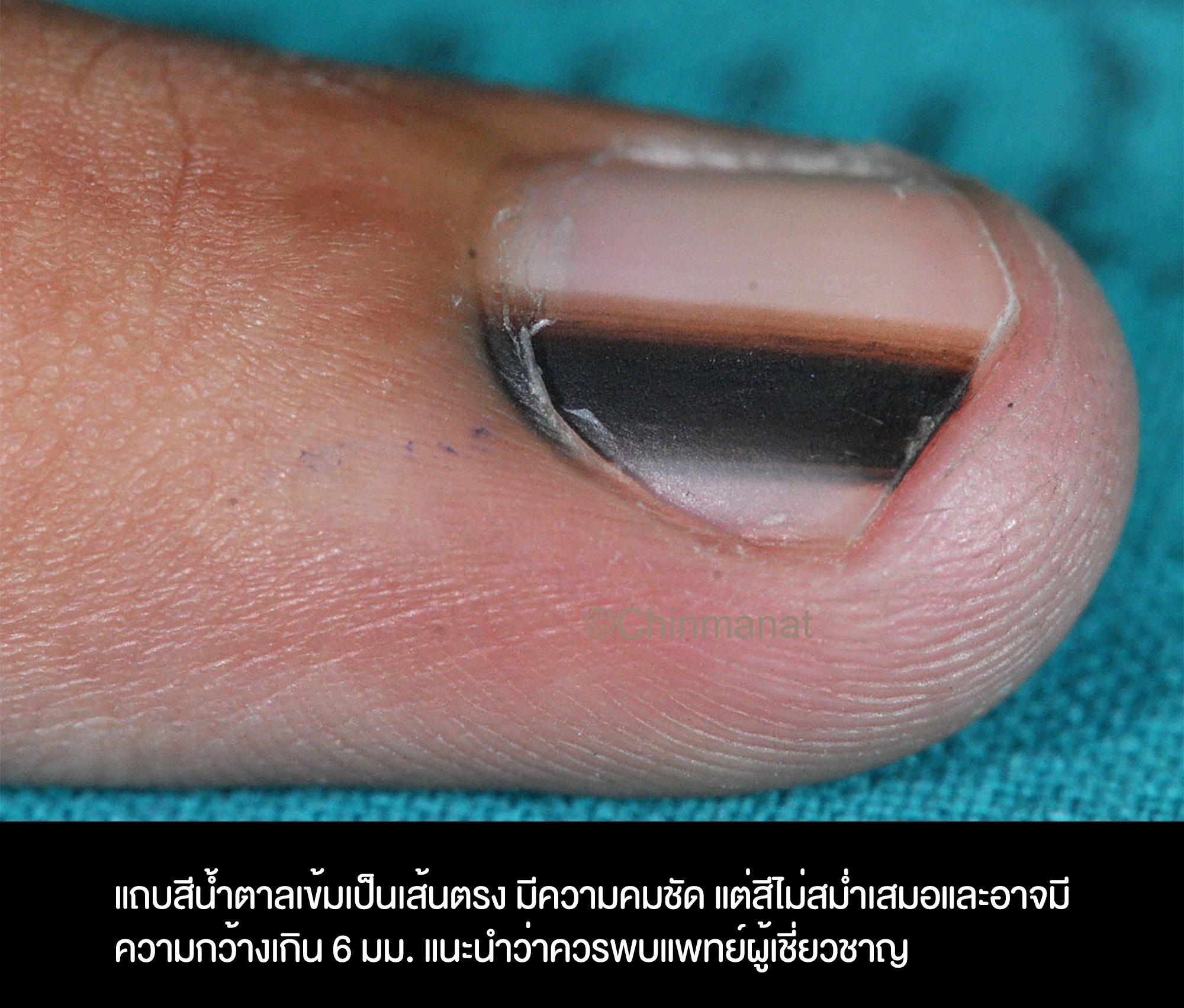 เปิดวิธีตรวจ เส้นสีน้ำตาลในเล็บ แบบไหนถึงเสี่ยงอาจเป็น “โรคมะเร็ง” เปิดวิธีตรวจ เส้นสีน้ำตาลในเล็บ แบบไหนถึงเสี่ยงอาจเป็น “โรคมะเร็ง”