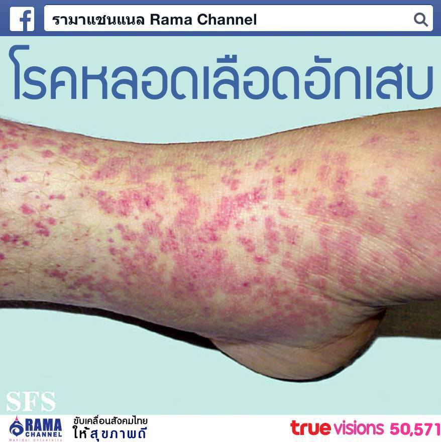 รู้จัก โรคหลอดเลือดอักเสบ เกิดจากอะไร มีอาการและรักษาอย่างไร?