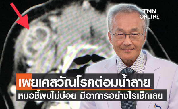 เช็กอาการเข้าข่าย! "หมอมนูญ" เผยเคสผู้ป่วยวัณโรคต่อมน้ำลาย