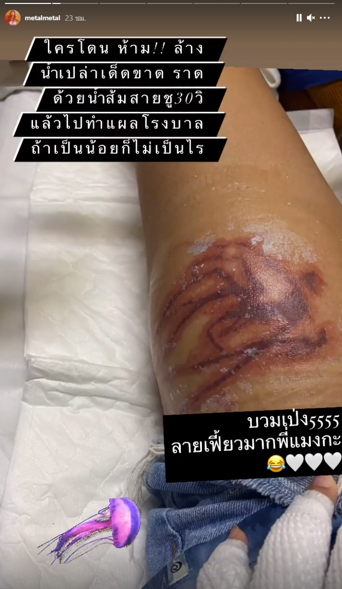'เมทัล' โดนแมงกะพรุนไฟเล่นงาน จนเป็นแผลไหม้ทั้งแขน-ขา