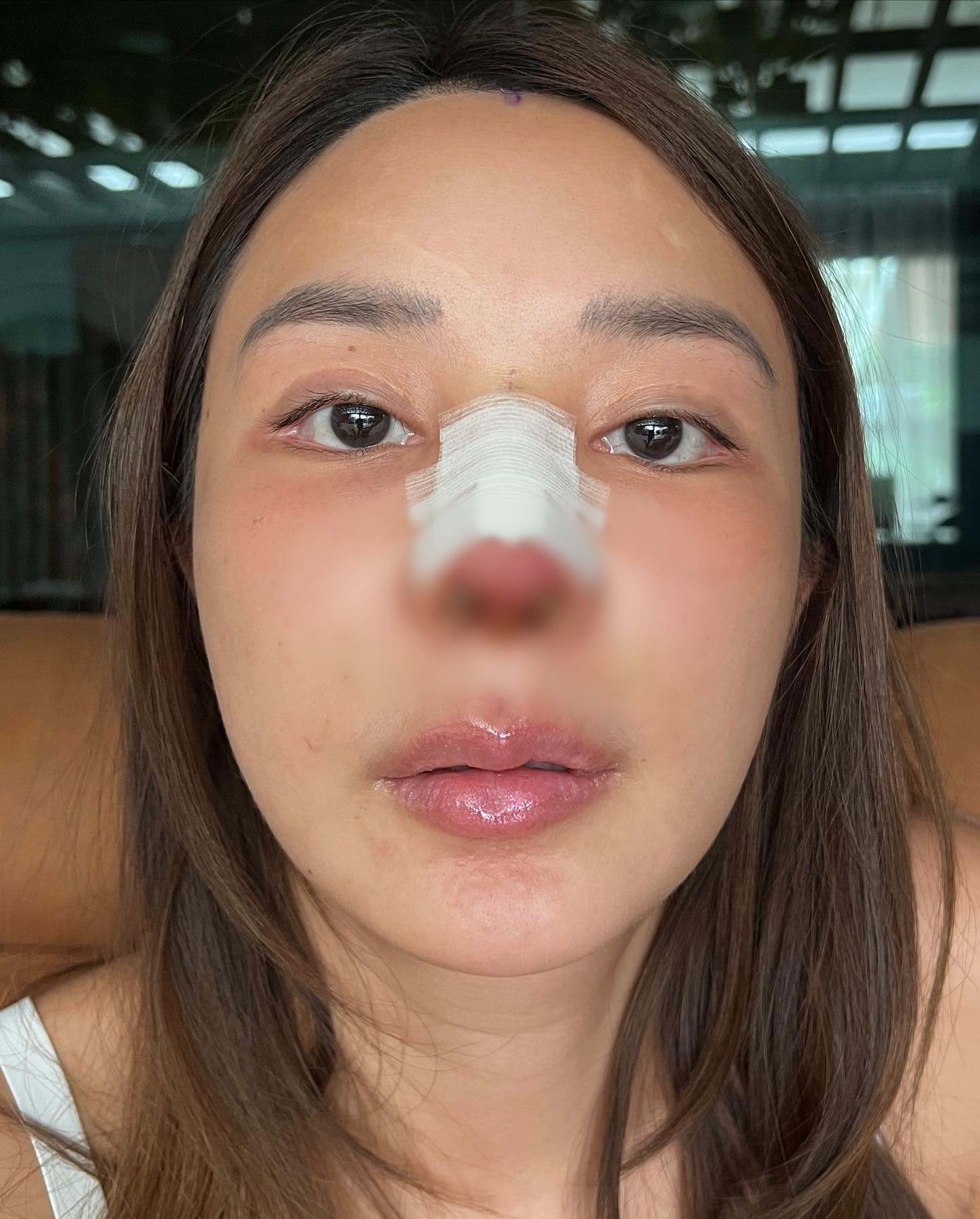เจอเนื้องอก 4 cm หญิงแย้ เผยผ่าตัดครั้งนี้ได้โชค 2 เด้ง ลั่น! แก้จมูกไม่ใช่เพราะอยากสวย