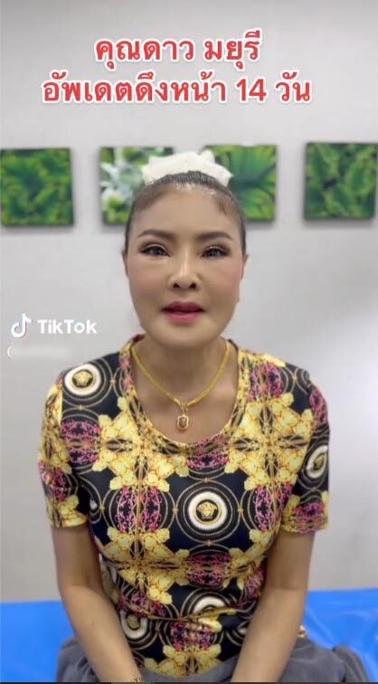 ตะลึงความสวย! ดาว มยุรี อัปเดตหน้าใหม่หลังทำศัลยกรรมครบ 14 วัน
