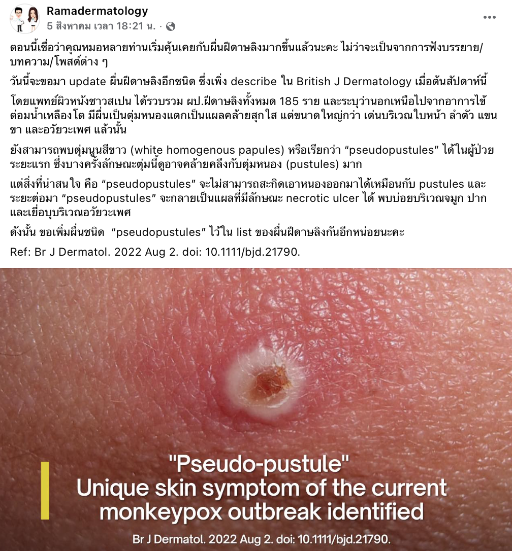 เผยข้อมูล ‘ผื่นโรคฝีดาษลิง’ แบบใหม่ พบในผู้ป่วยระยะแรก เผยข้อมูล ‘ผื่นโรคฝีดาษลิง’ แบบใหม่ พบในผู้ป่วยระยะแรก