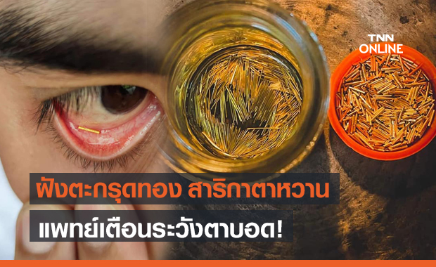 แพทย์ เตือน ฝังตะกรุดทอง "สาริกาตาหวาน" เสี่ยงตาบอด
