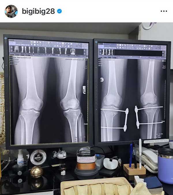 อัปเดตอาการล่าสุด บิ๊ก ศรุต หลังเข้ารับการผ่าตัดรักษา ขาฉิ่ง Knock knee อัปเดตอาการล่าสุด บิ๊ก ศรุต หลังเข้ารับการผ่าตัดรักษา ขาฉิ่ง Knock knee