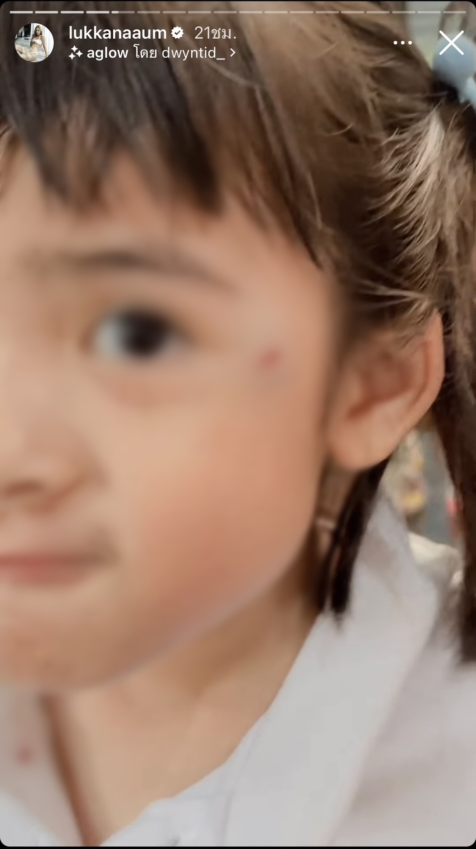 น้องดิสนีย์ ลูกสาว อุ้ม ลักขณา ได้รับบาดเจ็บ น้องดิสนีย์ ลูกสาว อุ้ม ลักขณา ได้รับบาดเจ็บ