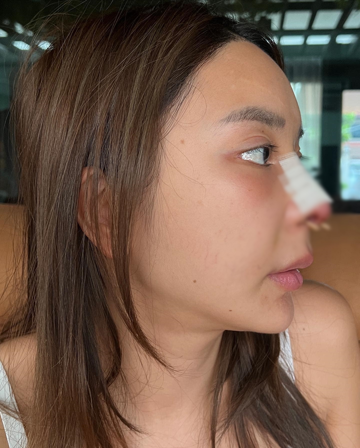 เจอเนื้องอก 4 cm หญิงแย้ เผยผ่าตัดครั้งนี้ได้โชค 2 เด้ง ลั่น! แก้จมูกไม่ใช่เพราะอยากสวย