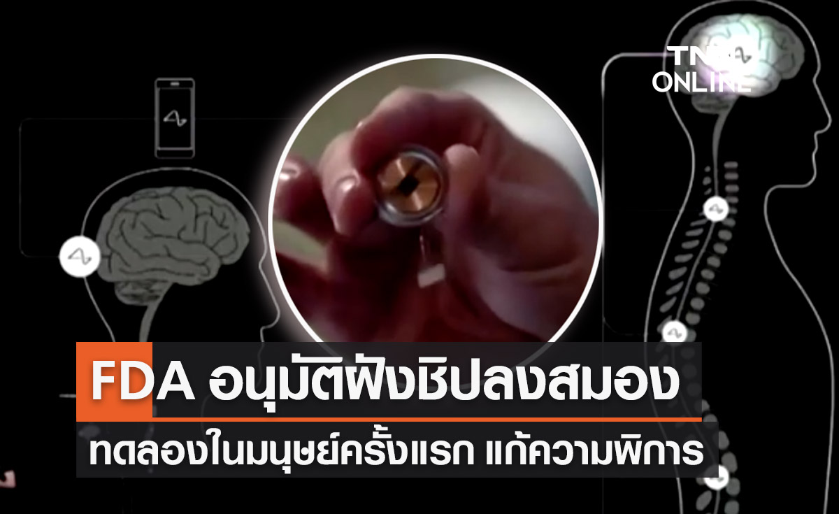 FDA อนุมัติ Neuralink ฝังชิปลงสมองทดลองกับมนุษย์ครั้งแรก