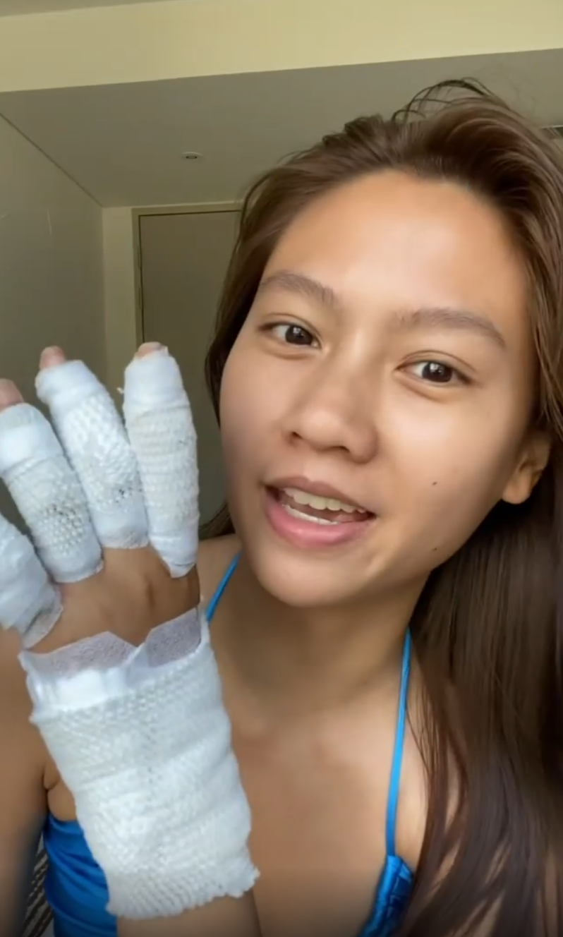 'เมทัล' โดนแมงกะพรุนไฟเล่นงาน จนเป็นแผลไหม้ทั้งแขน-ขา