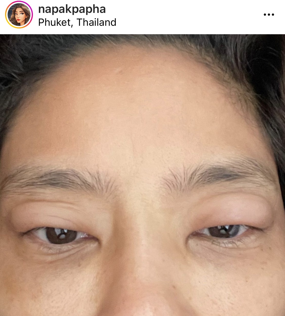 มะหมี่ นภคปภา เกิดอาการแพ้น้ำยาซักผ้ารุนแรง ถึงขั้นหายใจไม่ออก ตาบวม มะหมี่ นภคปภา เกิดอาการแพ้น้ำยาซักผ้ารุนแรง ถึงขั้นหายใจไม่ออก ตาบวม