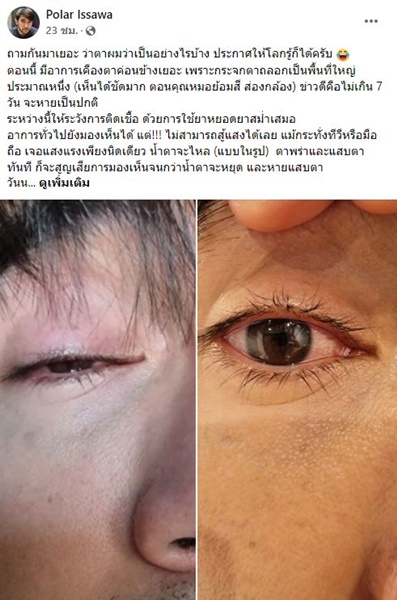 ไพลาร์ ชยพล  อาการที่ตาดีขึ้น หลังถูกสัตว์เลี้ยงตะปบตา