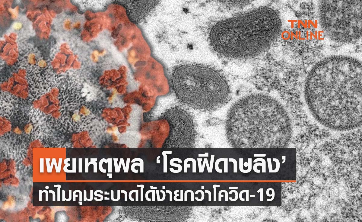 ศูนย์จีโนมฯเผยเหตุผลทำไม ‘โรคฝีดาษลิง’ ถึงคุมระบาดได้ไม่ยาก