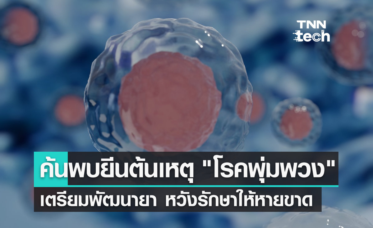 นักวิจัยค้นพบยีนต้นเหตุ "โรคพุ่มพวง" หวังพัฒนายาพุ่งเป้ารักษาให้หายขาด