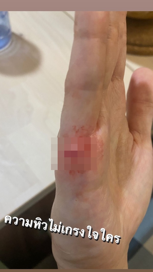 กอล์ฟ พิชญะ หิวมือสั่น จานหลุดมือ เย็บ 5 เข็ม!! กอล์ฟ พิชญะ หิวมือสั่น จานหลุดมือ เย็บ 5 เข็ม!!