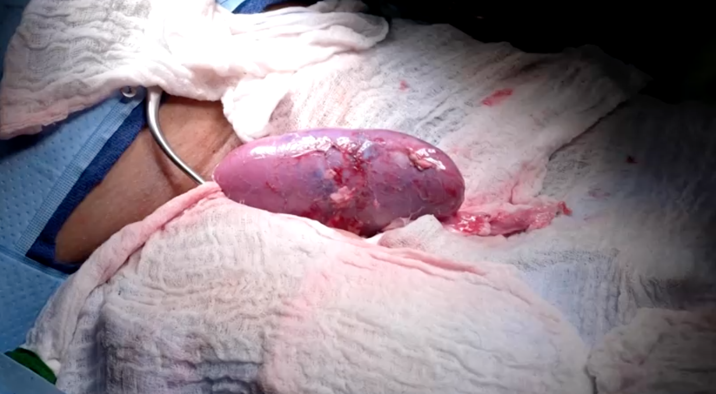 แพทย์สหรัฐฯปลูกถ่ายไตของหมูในมนุษย์สำเร็จเป็นครั้งแรก แพทย์สหรัฐฯปลูกถ่ายไตของหมูในมนุษย์สำเร็จเป็นครั้งแรก