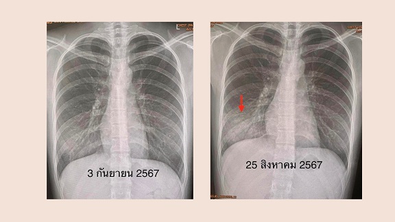ปอดเป็นฝ้าขาว ติดเชื้อไมโคพลาสมา ยังไม่มีวัคซีนป้องกัน เช็กสัญญาณอาการ ? ปอดเป็นฝ้าขาว ติดเชื้อไมโคพลาสมา ยังไม่มีวัคซีนป้องกัน เช็กสัญญาณอาการ ?