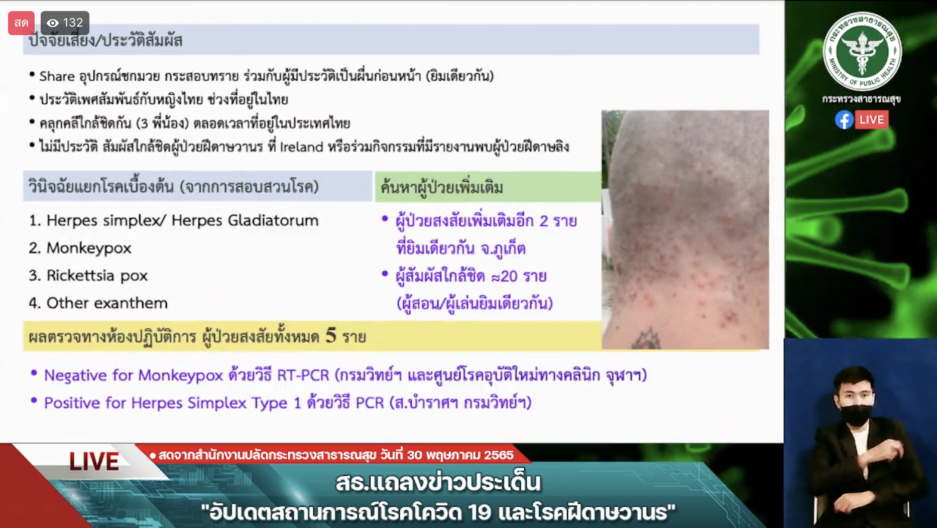 ยืนยันไทยยังไม่พบผู้ป่วยโรคฝีดาษลิง ติดตาม 12 รายใกล้ชิดผู้ป่วยระหว่าเดินทาง ยังปลอดภัย ยืนยันไทยยังไม่พบผู้ป่วยโรคฝีดาษลิง ติดตาม 12 รายใกล้ชิดผู้ป่วยระหว่าเดินทาง ยังปลอดภัย