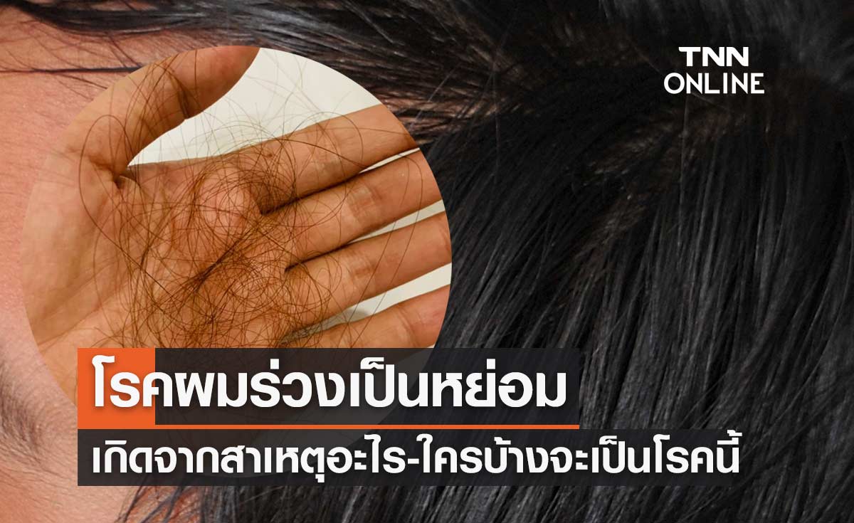 โรคผมร่วงเป็นหย่อม เกิดจากสาเหตุอะไร? แม้ไม่อันตราย แต่มีผลกระทบด้านจิตใจ