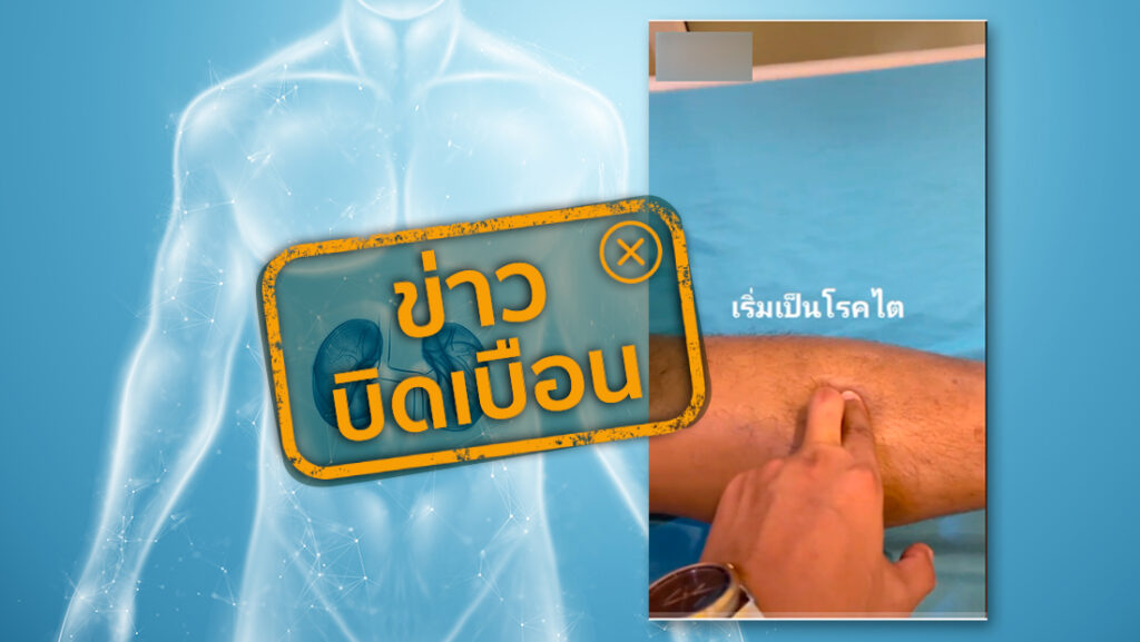 5 สัญญาณเตือน โรคไต ใช้นิ้วมือกดขาเช็กอาการเริ่มปวยได้จริงหรือ?
