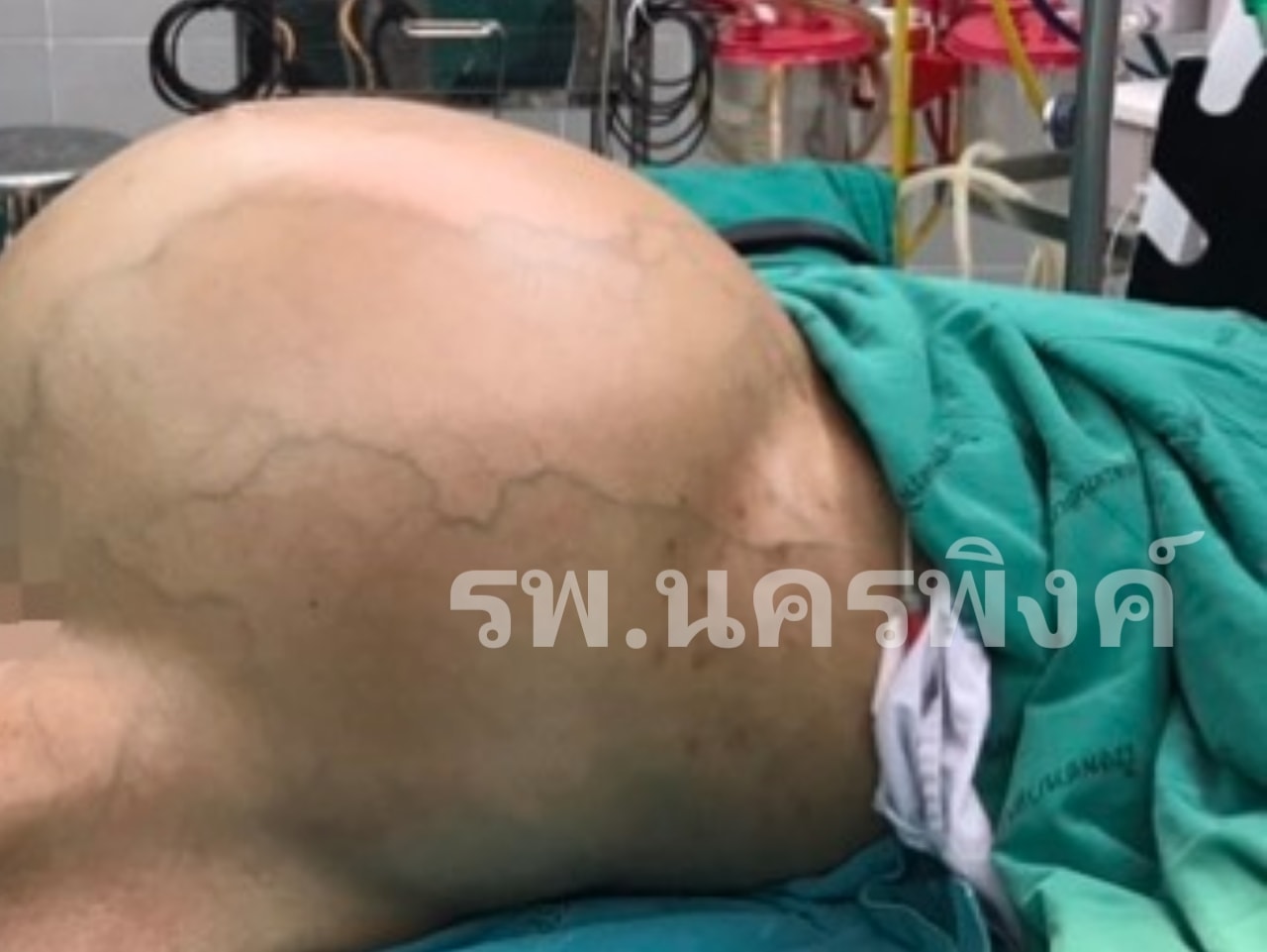 แพทย์ไทยเจ๋ง! ผ่าตัด มะเร็งรังไข่ ขนาดยักษ์ หนักกว่า 25 กก.สำเร็จ แพทย์ไทยเจ๋ง! ผ่าตัด มะเร็งรังไข่ ขนาดยักษ์ หนักกว่า 25 กก.สำเร็จ