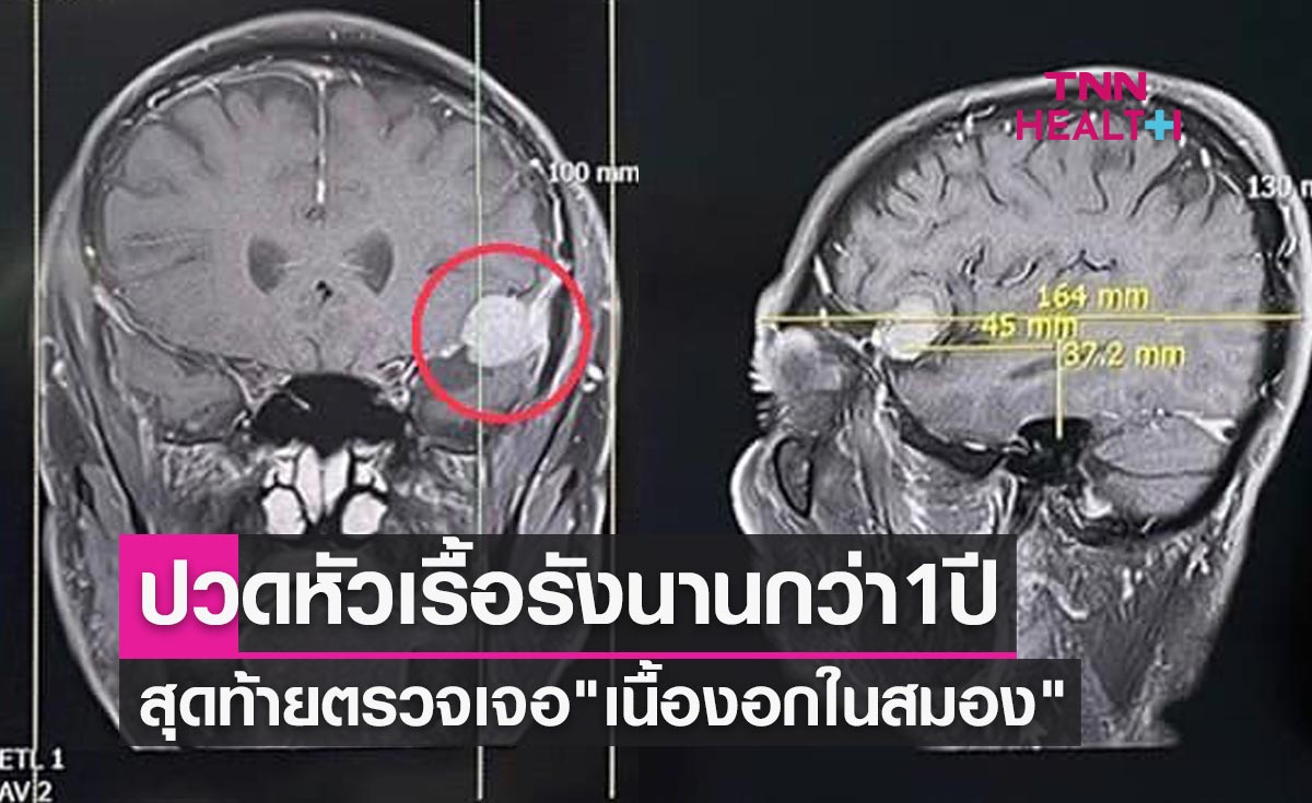เตือนอย่าละเลย! ปวดหัวเรื้อรังนานกว่า 1 ปี สุดท้ายตรวจเจอ เนื้องอกในสมอง