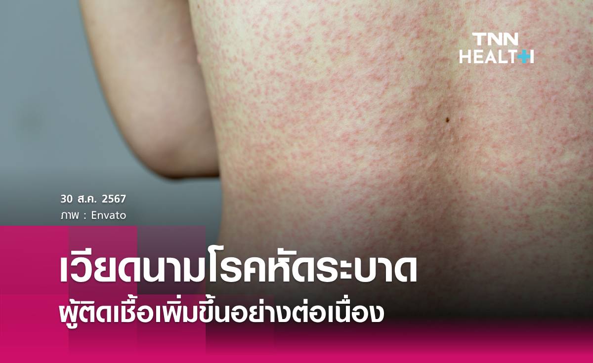 เวียดนามโรคหัดระบาด เสียชีวิตแล้ว 3 คน