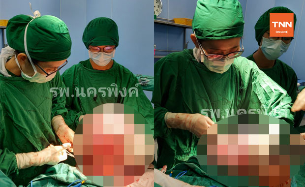 แพทย์ไทยเจ๋ง! ผ่าตัด มะเร็งรังไข่ ขนาดยักษ์ หนักกว่า 25 กก.สำเร็จ แพทย์ไทยเจ๋ง! ผ่าตัด มะเร็งรังไข่ ขนาดยักษ์ หนักกว่า 25 กก.สำเร็จ