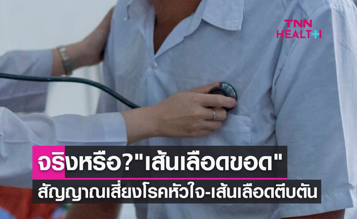 "เส้นเลือดขอด" สัญญาณเสี่ยงโรคหัวใจ-เส้นเลือดตีบตันจริงหรือ?