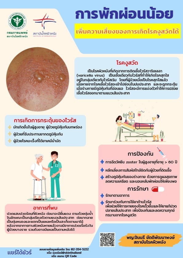 แพทย์ผิวหนังชี้การพักผ่อนน้อยเพิ่มความเสี่ยงของการเกิดโรคงูสวัดได้