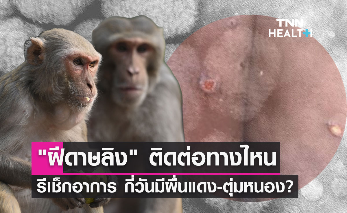 "ฝีดาษลิง" ติดต่อทางไหน อาการเป็นอย่างไร กี่วันมีผื่นแดง ตุ่มหนอง?