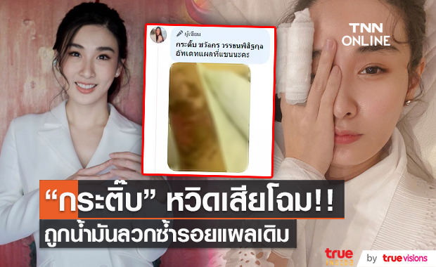  “กระติ๊บ ชวัลกร” หวิดเสียโฉม หลังถูกน้ำมันลวกครั้งที่ 2 (มีคลิป)