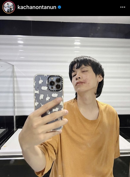 คชา นนทนันท์ เจอพิษแมลงก้นกระดก ผื่นขึ้นบนใบหน้า