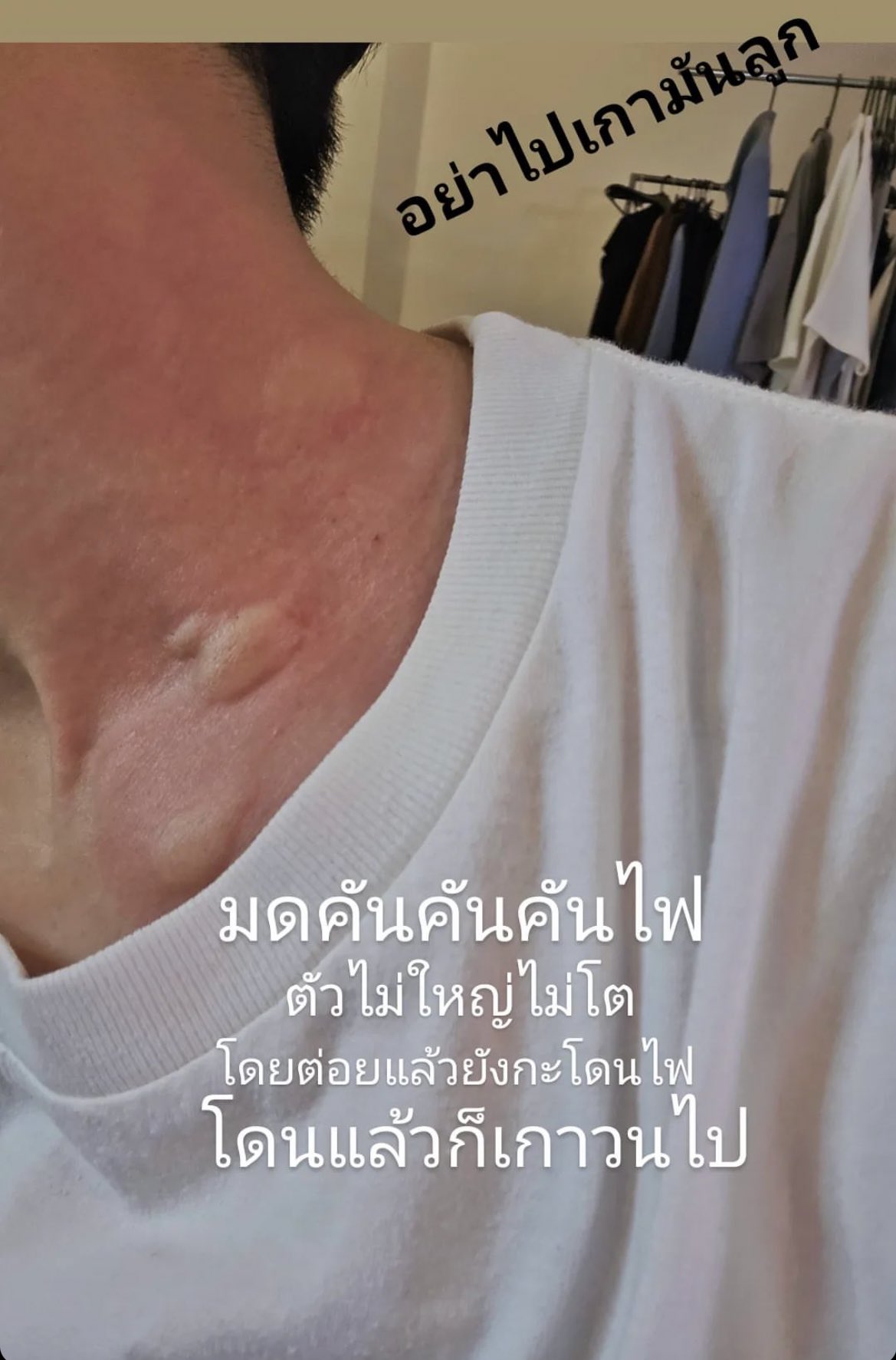 ฟนคลับเป็นห่วง!เต ตะวัน ถูกมดกัด พิษลามหนัก ฟนคลับเป็นห่วง!เต ตะวัน ถูกมดกัด พิษลามหนัก