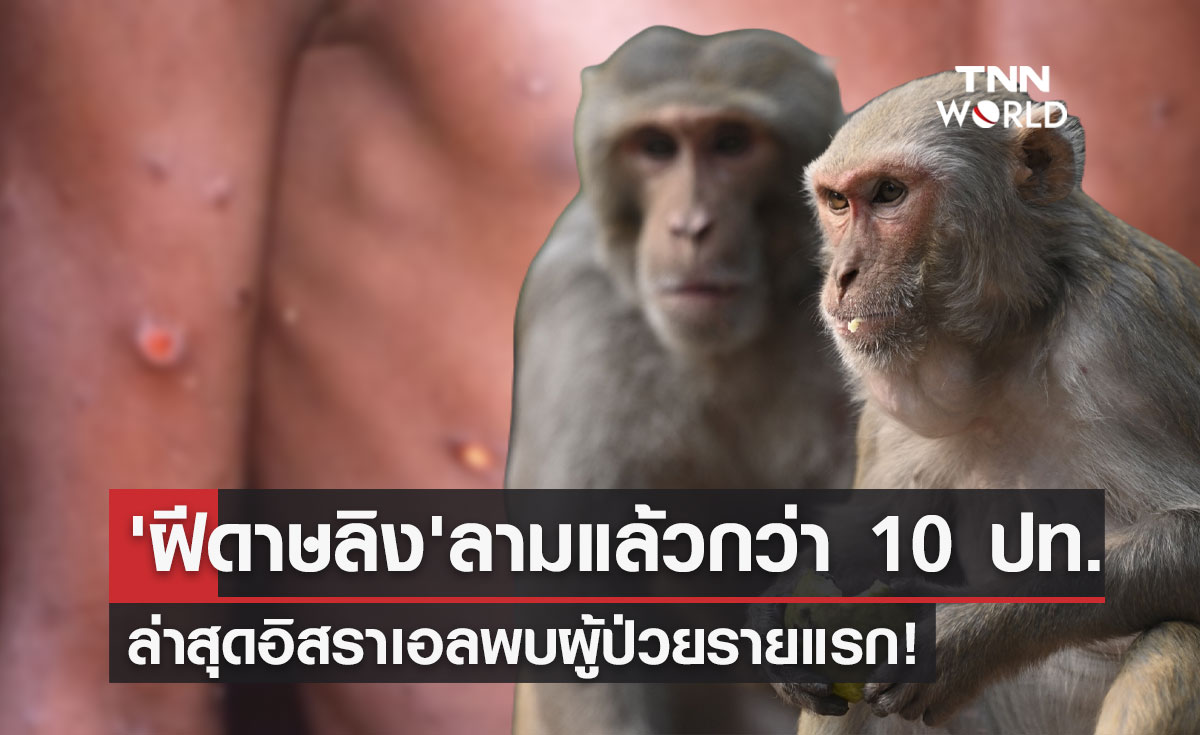 "ฝีดาษลิง" ลามกว่า 10 ประเทศ ล่าสุดอิสราเอลพบแล้วรายแรก!