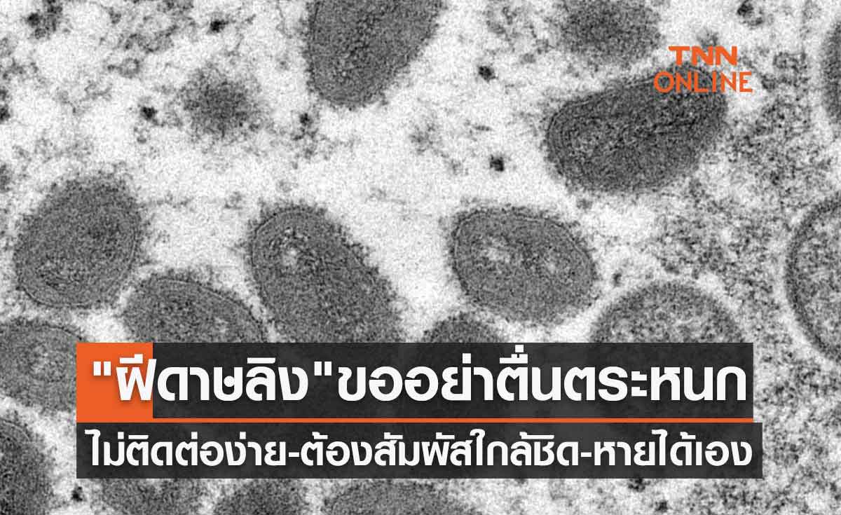 อย่าตื่นตระหนก "ฝีดาษลิง" ไม่ติดต่อง่าย-ต้องสัมผัสใกล้ชิด-หายได้เอง