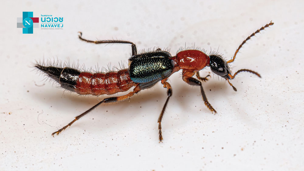 ภัยเงียบ! ที่มักพบบ่อยมาพร้อมกับฤดูฝน....ผื่นผิวหนังอักเสบจากแมลงก้นกระดก ภัยเงียบ! ที่มักพบบ่อยมาพร้อมกับฤดูฝน....ผื่นผิวหนังอักเสบจากแมลงก้นกระดก