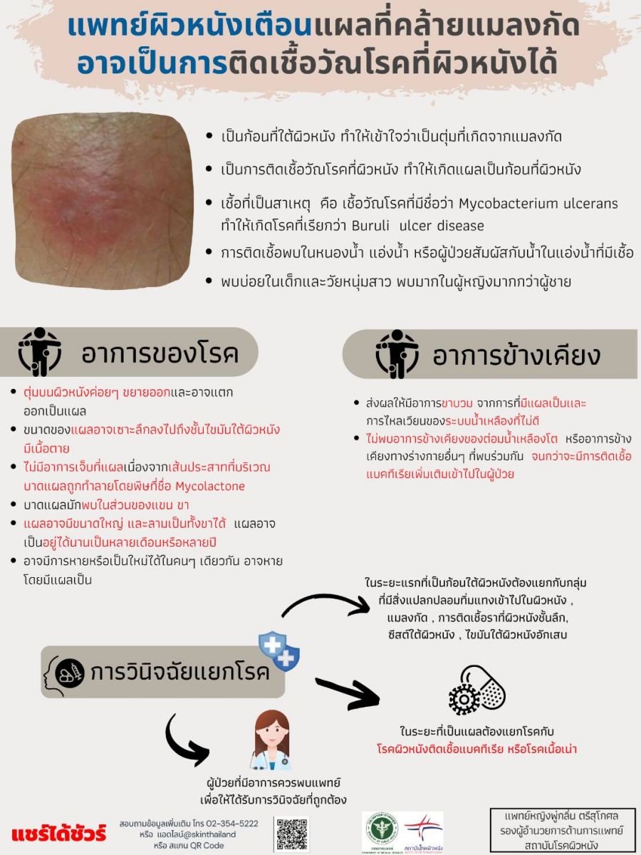 แพทย์ผิวหนังเตือน! แผลที่คล้ายแมลงกัด อาจเป็นการติดเชื้อวัณโรคที่ผิวหนังได้