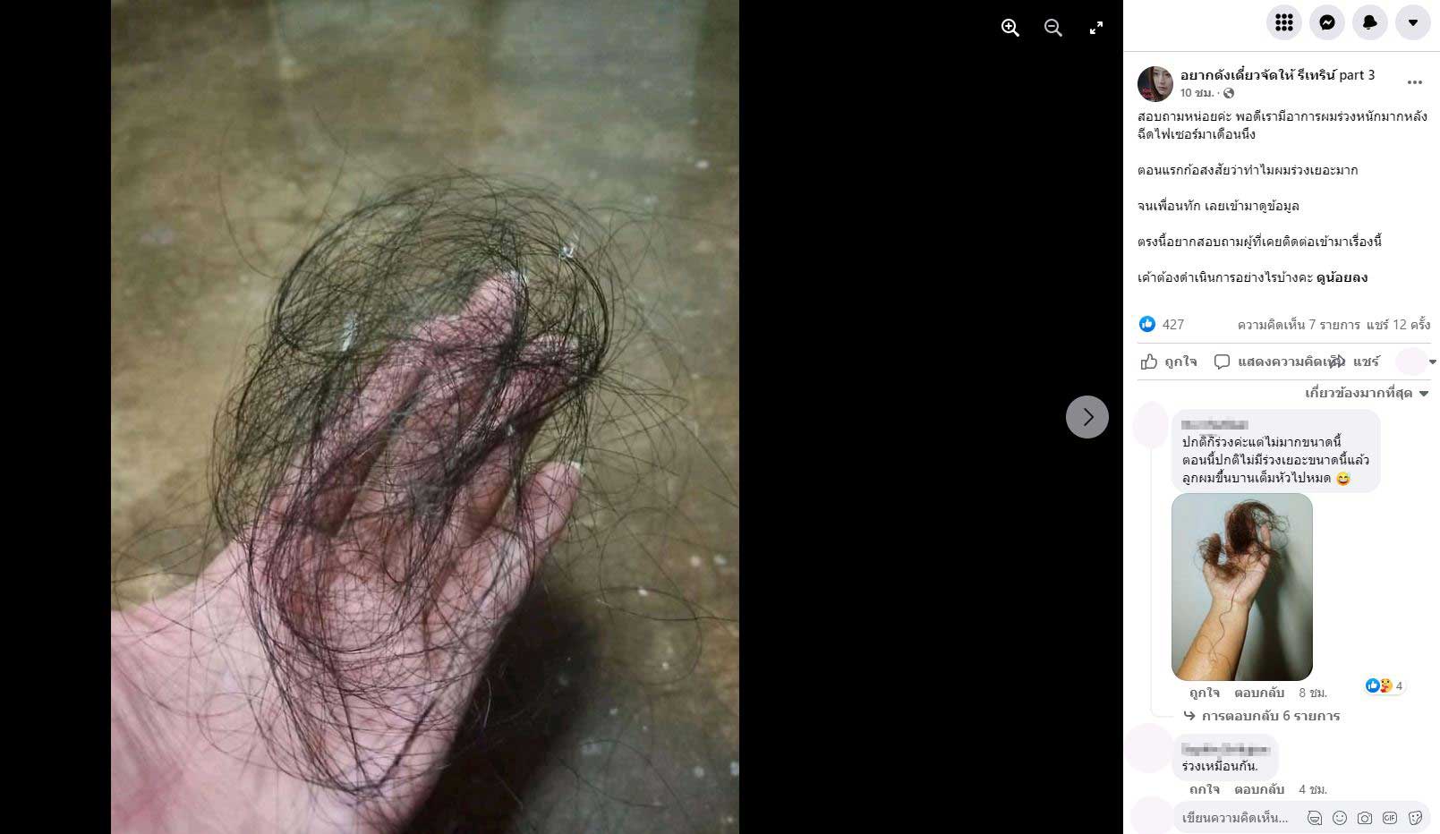 สาวผมร่วงหลังฉีดวัคซีนป้องกันโควิด-19 ของไฟเซอร์ 1 เดือน