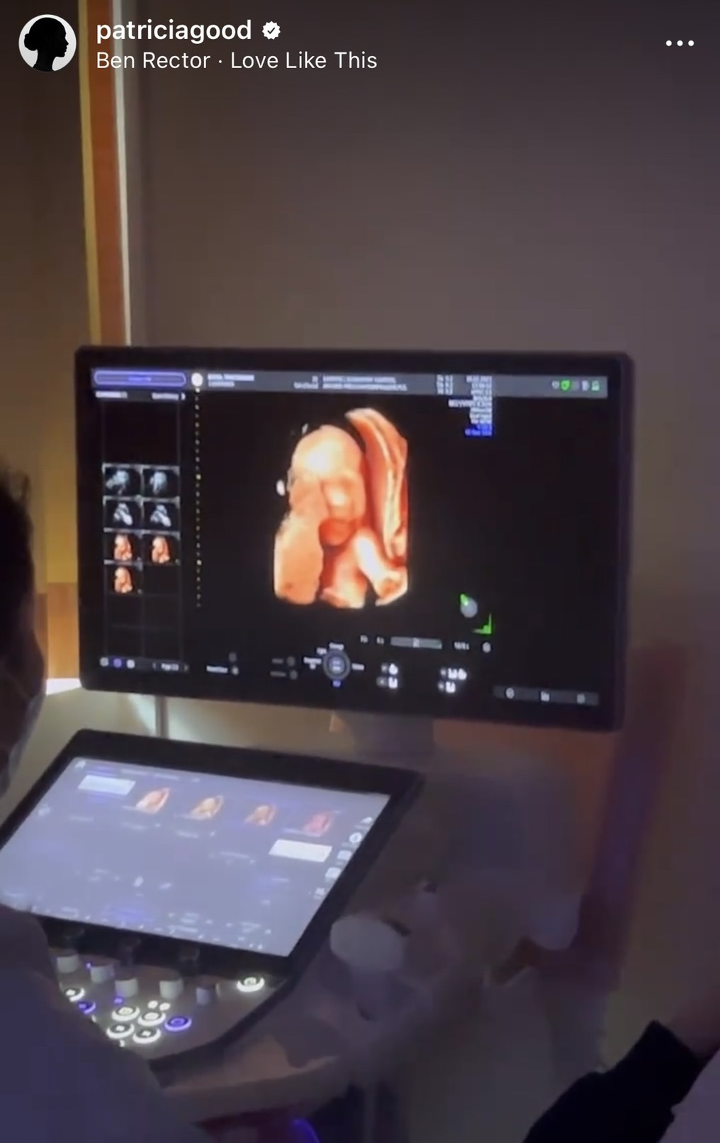 แพทริเซีย ตื่นเต้น รับบทบาทคุณแม่มือใหม่ เผย ภาพอัลตร้าซาวด์